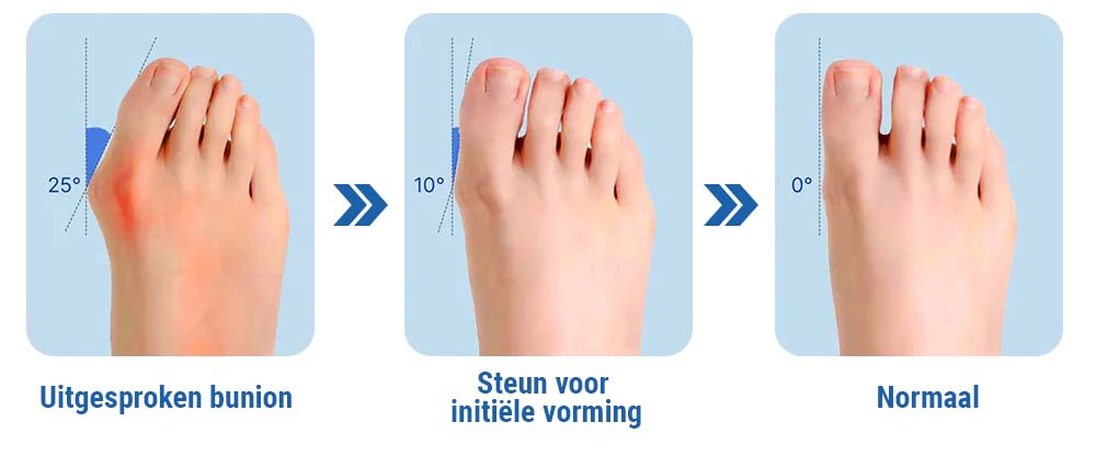 SoleSoothe™ Bunion Verlichtings Sokken