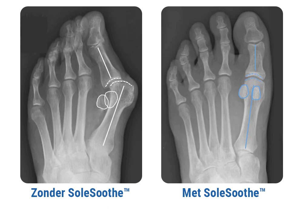 SoleSoothe™ Bunion Verlichtings Sokken